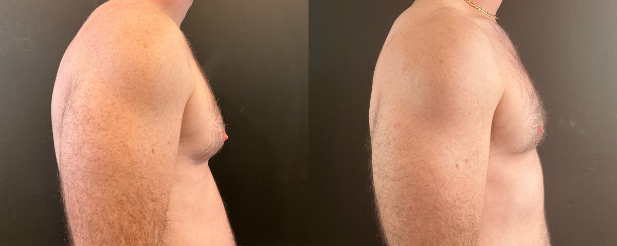 Male Breast Reduction (Gynecomastia) Before & After Gallery - Patient 162210 - Image 3