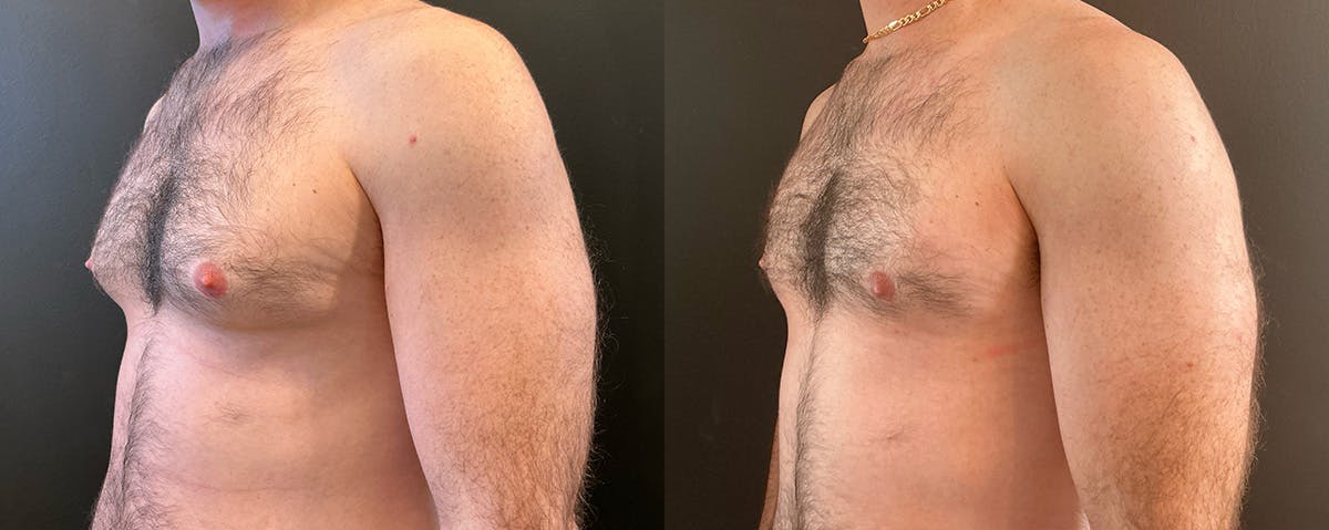 Male Breast Reduction (Gynecomastia) Before & After Gallery - Patient 162210 - Image 2