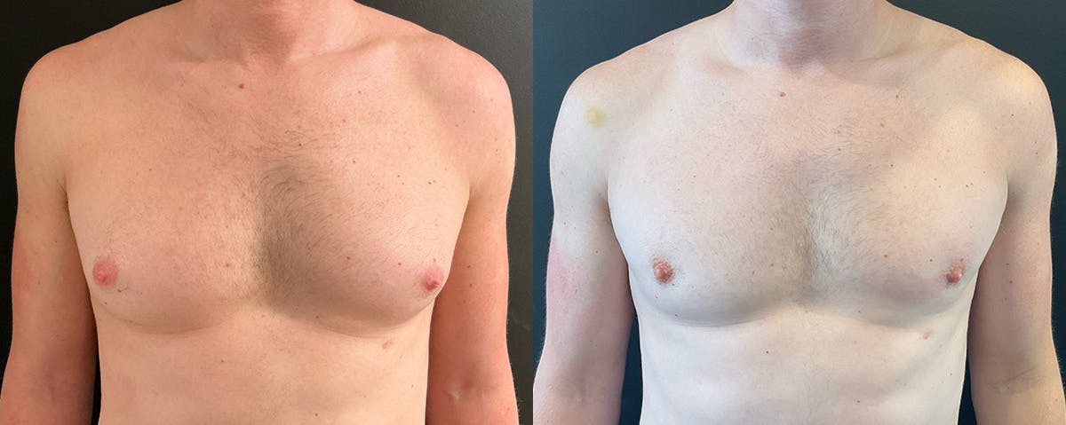 Male Breast Reduction (Gynecomastia) Before & After Gallery - Patient 411169 - Image 1