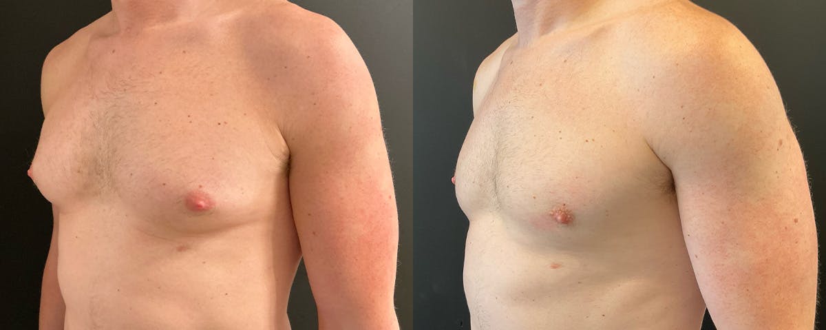 Male Breast Reduction (Gynecomastia) Before & After Gallery - Patient 411169 - Image 2