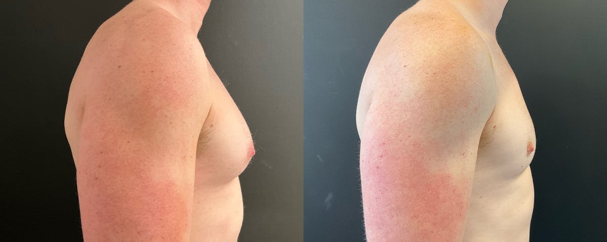 Male Breast Reduction (Gynecomastia) Before & After Gallery - Patient 411169 - Image 3