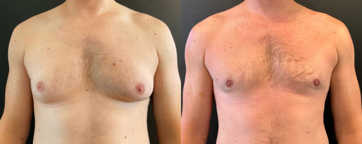 Male Breast Reduction (Gynecomastia) Before & After Gallery - Patient 222758 - Image 1