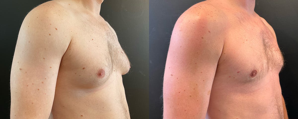 Male Breast Reduction (Gynecomastia) Before & After Gallery - Patient 222758 - Image 2