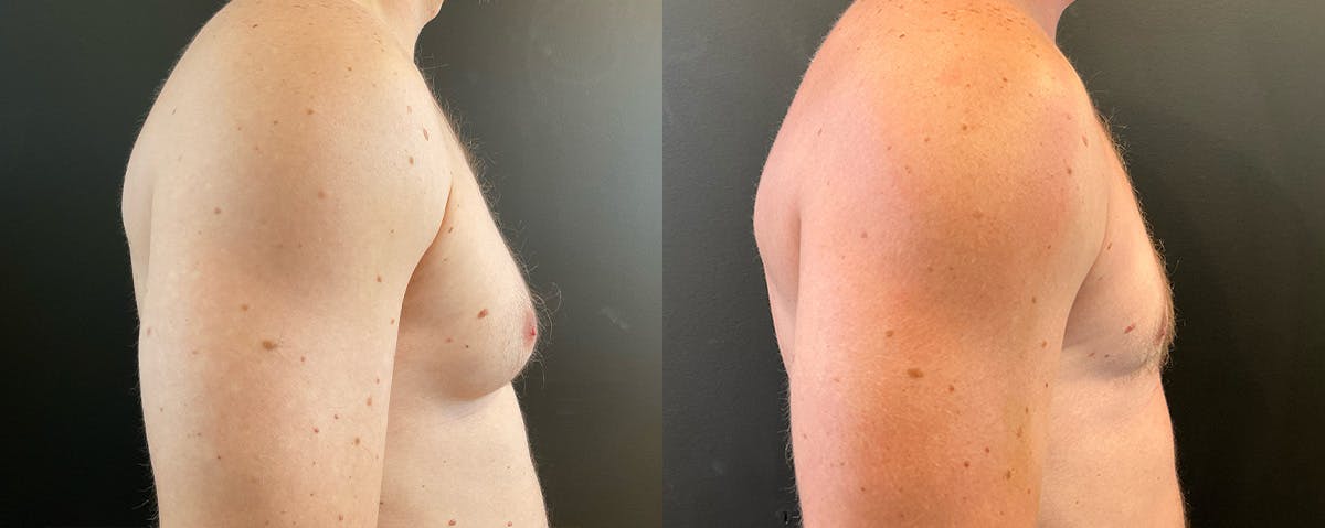 Male Breast Reduction (Gynecomastia) Before & After Gallery - Patient 222758 - Image 3