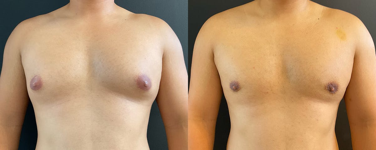 Male Breast Reduction (Gynecomastia) Before & After Gallery - Patient 289705 - Image 1