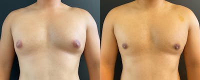 Male Breast Reduction (Gynecomastia) Before & After Gallery - Patient 289705 - Image 1