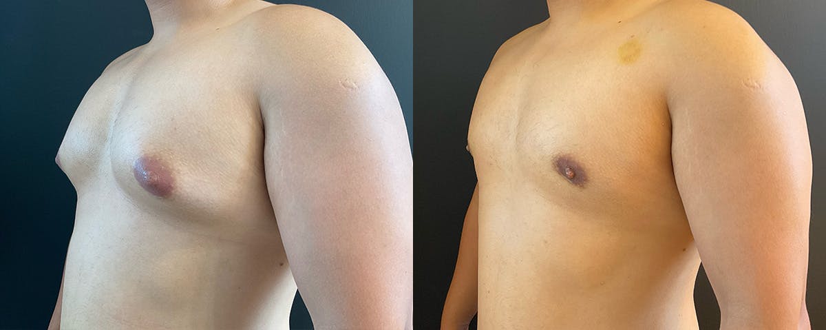 Male Breast Reduction (Gynecomastia) Before & After Gallery - Patient 289705 - Image 2