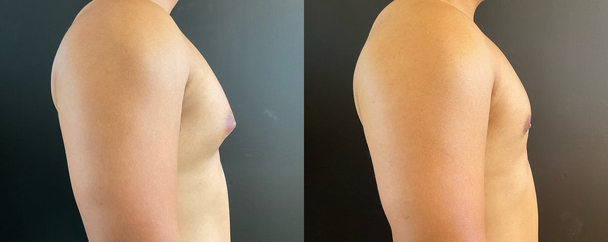 Male Breast Reduction (Gynecomastia) Before & After Gallery - Patient 289705 - Image 3