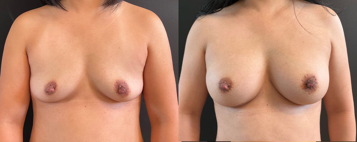 Breast Augmentation Before & After Gallery - Patient 320004 - Image 1