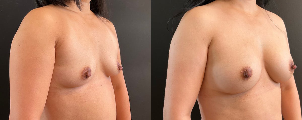 Breast Augmentation Before & After Gallery - Patient 320004 - Image 2
