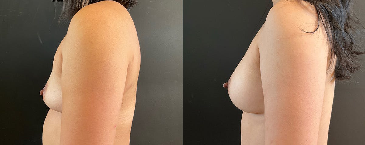 Breast Augmentation Before & After Gallery - Patient 320004 - Image 3