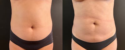 Liposuction Before & After Gallery - Patient 172276 - Image 1