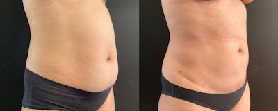 Liposuction and Fat Transfer Before & After Gallery - Patient 172276 - Image 2