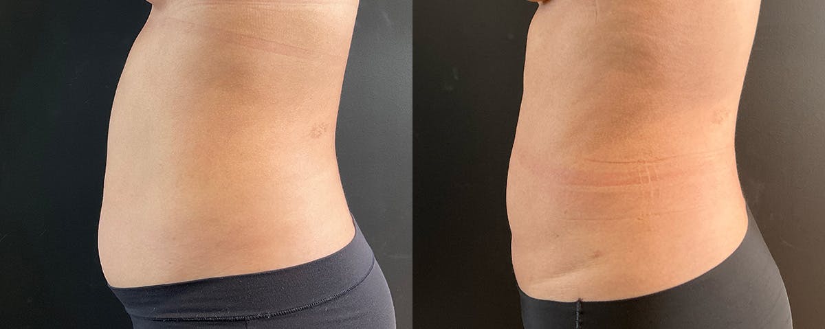 Liposuction Before & After Gallery - Patient 172276 - Image 3