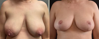 Mommy Makeover Before & After Gallery - Patient 173227 - Image 1