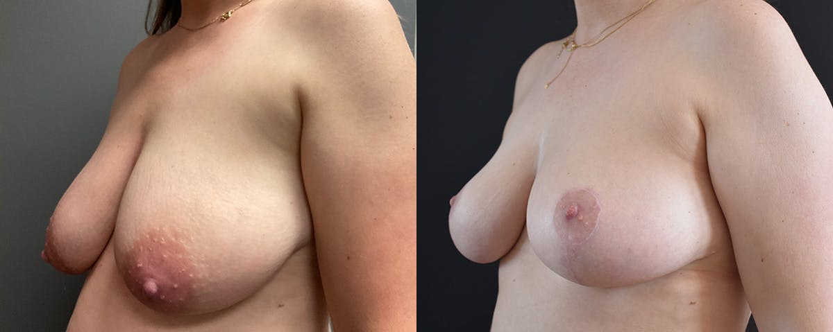 Mommy Makeover Before & After Gallery - Patient 173227 - Image 2