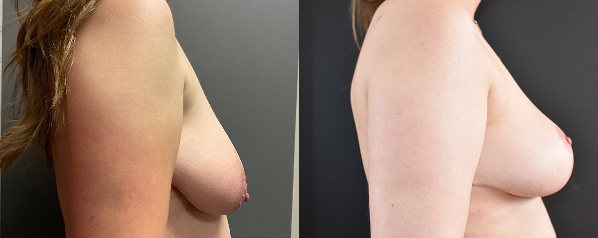 Mommy Makeover Before & After Gallery - Patient 173227 - Image 3