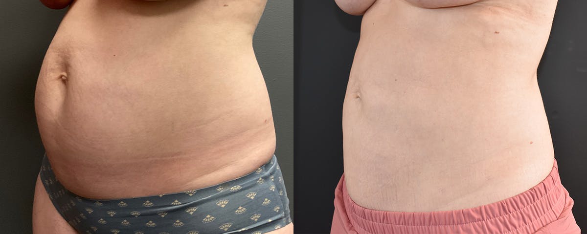 Mommy Makeover Before & After Gallery - Patient 173227 - Image 4