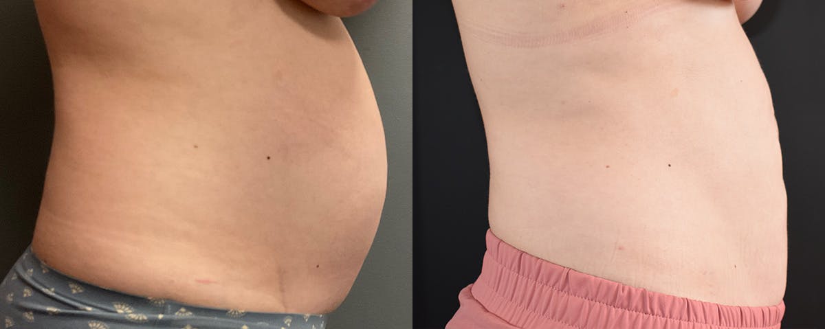 Mommy Makeover Before & After Gallery - Patient 173227 - Image 5