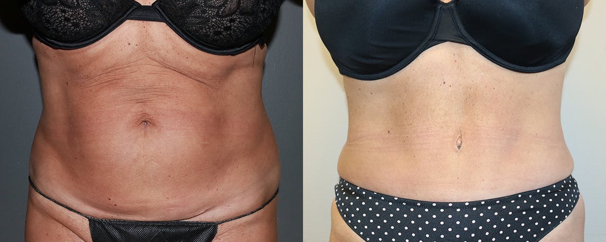 Mommy Makeover Before & After Gallery - Patient 353074 - Image 4