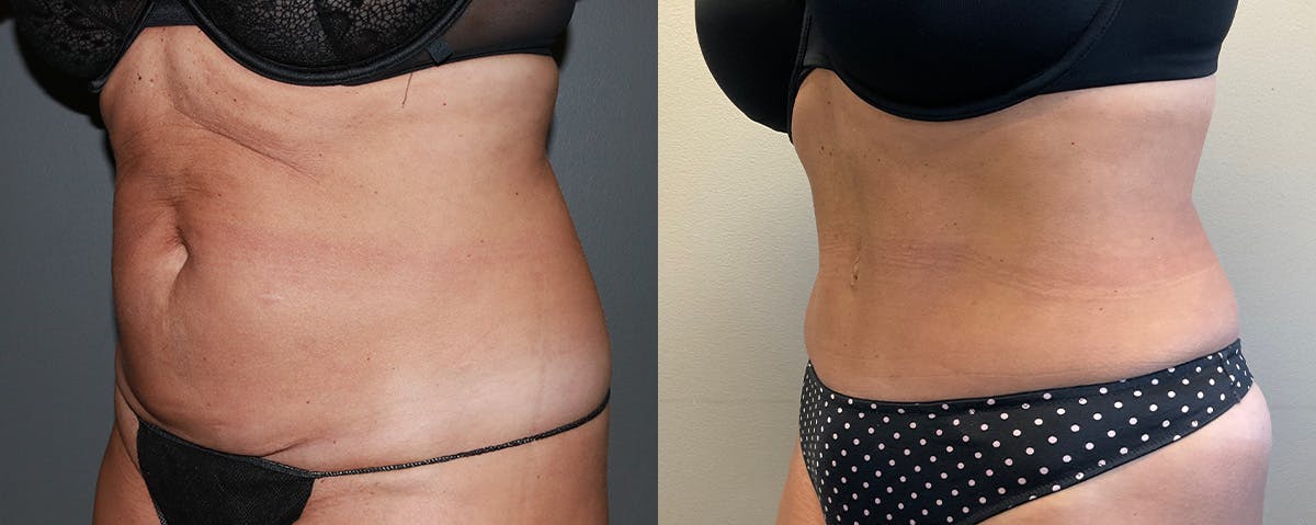 Mommy Makeover Before & After Gallery - Patient 353074 - Image 5