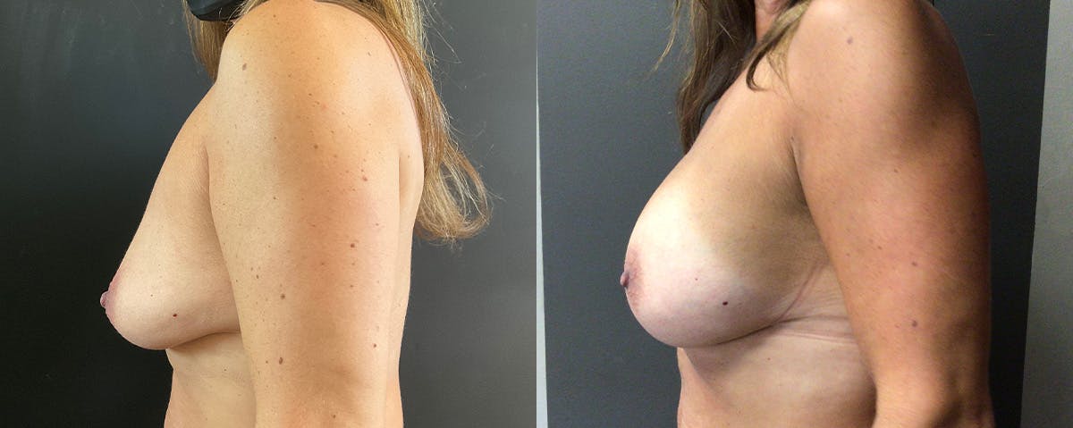 Mommy Makeover Before & After Gallery - Patient 353074 - Image 3