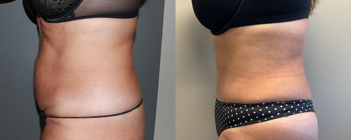 Mommy Makeover Before & After Gallery - Patient 353074 - Image 6