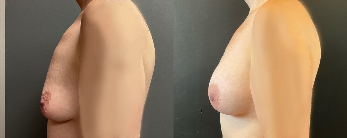 Breast Augmentation Before & After Gallery - Patient 483849 - Image 3