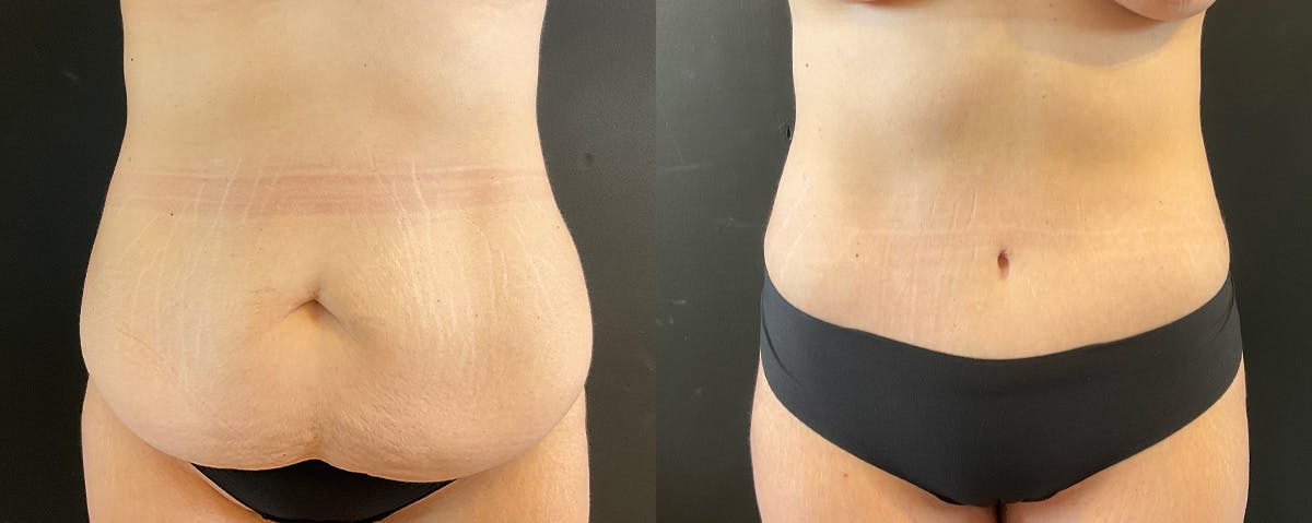 Mommy Makeover Before & After Gallery - Patient 308663 - Image 4