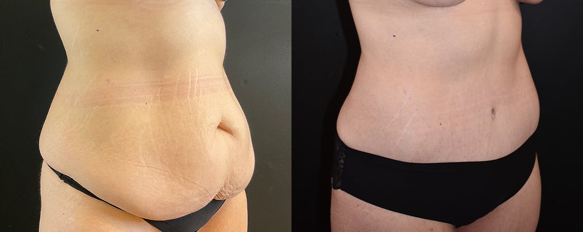 Mommy Makeover Before & After Gallery - Patient 308663 - Image 5