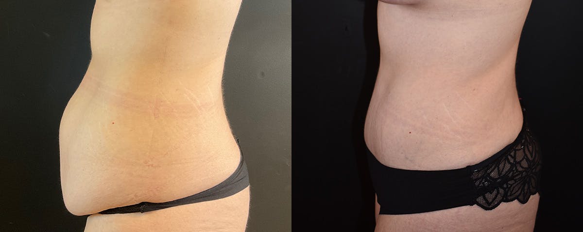 Mommy Makeover Before & After Gallery - Patient 308663 - Image 6