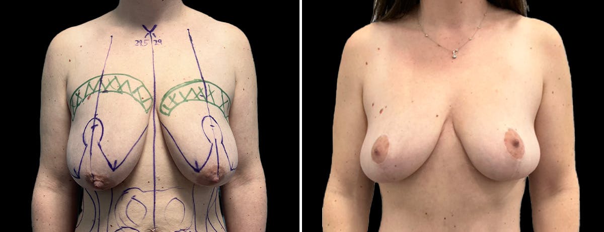 Breast Lift Before & After Gallery - Patient 197388 - Image 1