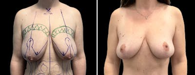 Breast Lift Before & After Gallery - Patient 197388 - Image 1