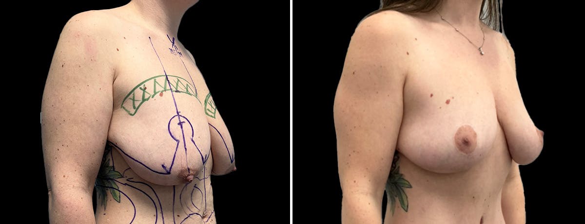 Breast Lift Before & After Gallery - Patient 197388 - Image 2
