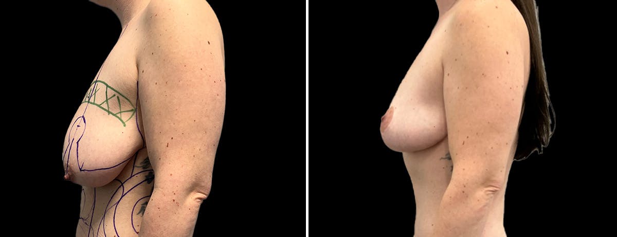Breast Lift Before & After Gallery - Patient 197388 - Image 3