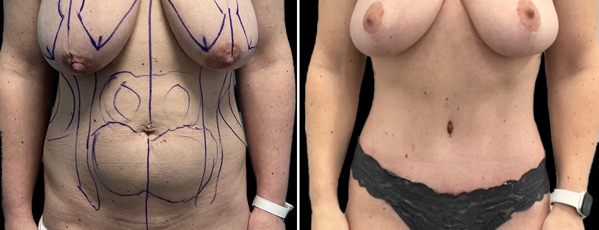 Abdominoplasty (Tummy Tuck) Before & After Gallery - Patient 313025 - Image 1