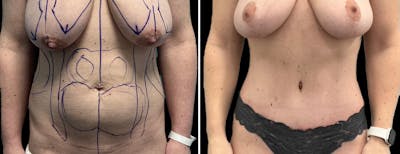 Abdominoplasty (Tummy Tuck) Before & After Gallery - Patient 313025 - Image 1