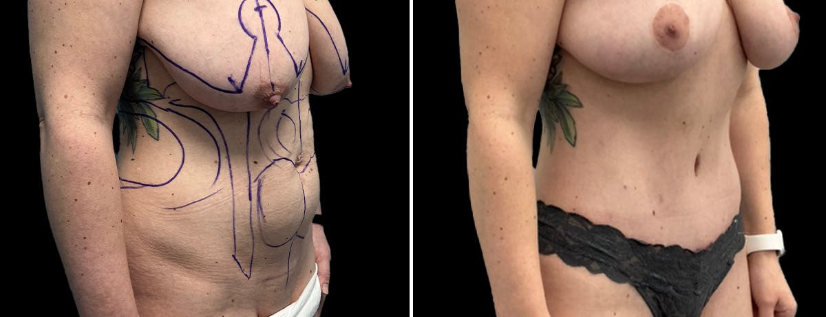 Abdominoplasty (Tummy Tuck) Before & After Gallery - Patient 313025 - Image 2