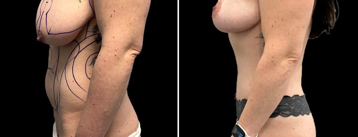 Abdominoplasty (Tummy Tuck) Before & After Gallery - Patient 313025 - Image 3