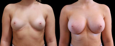 Breast Augmentation Before & After Gallery - Patient 192303 - Image 1