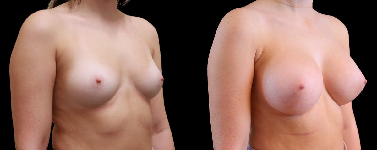 Breast Augmentation Before & After Gallery - Patient 192303 - Image 2