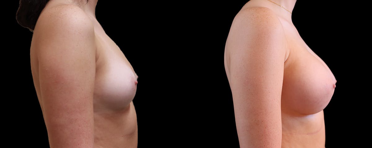 Breast Augmentation Before & After Gallery - Patient 192303 - Image 3