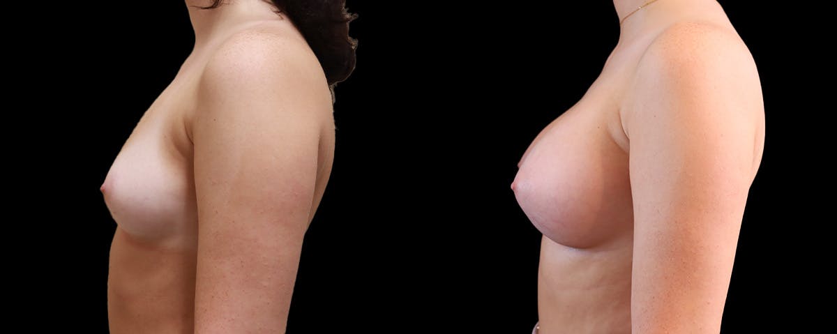 Breast Augmentation Before & After Gallery - Patient 192303 - Image 5