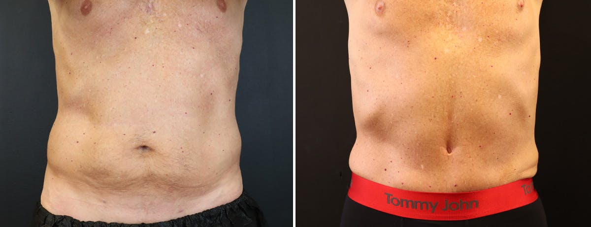 Abdominoplasty (Tummy Tuck) Before & After Gallery - Patient 410114 - Image 1
