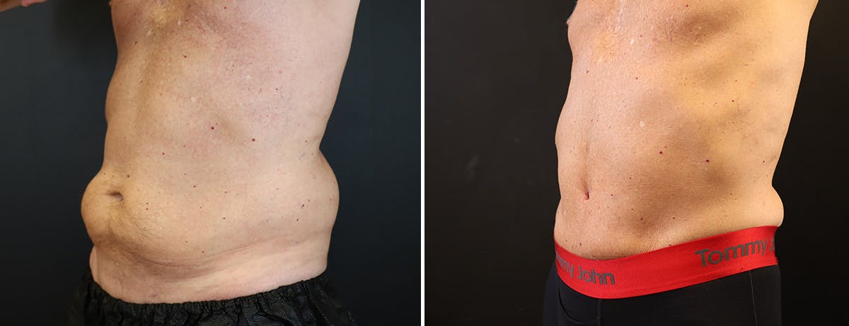 Abdominoplasty (Tummy Tuck) Before & After Gallery - Patient 410114 - Image 2