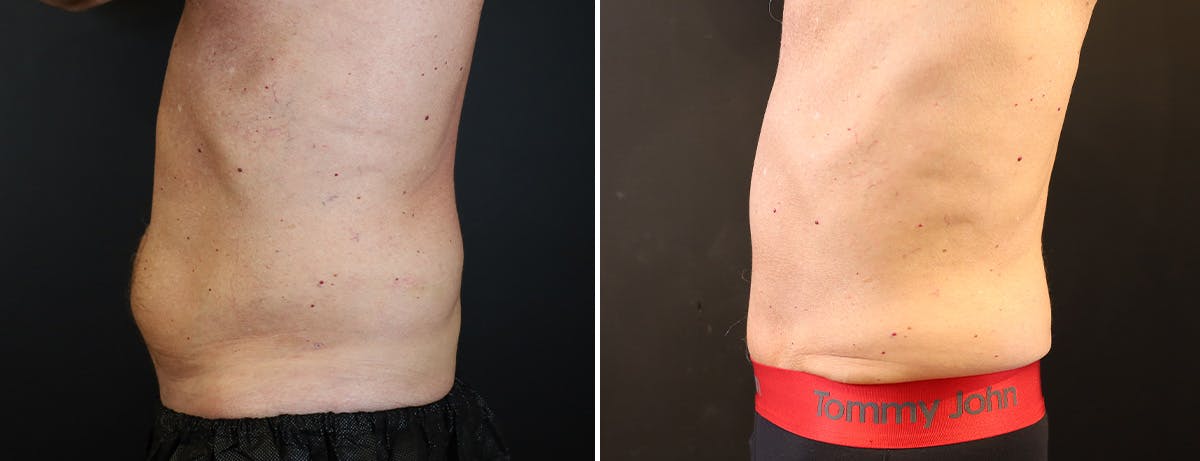 Abdominoplasty (Tummy Tuck) Before & After Gallery - Patient 410114 - Image 3