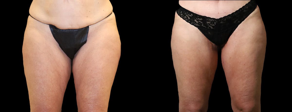 Thigh Lift Before & After Gallery - Patient 267389 - Image 1