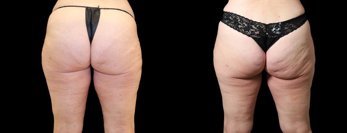 Thigh Lift Before & After Gallery - Patient 267389 - Image 3