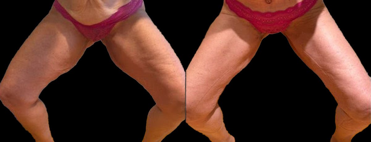 Thigh Lift Before & After Gallery - Patient 267389 - Image 2