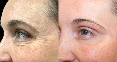 Botox Before & After Gallery - Patient 958205 - Image 1